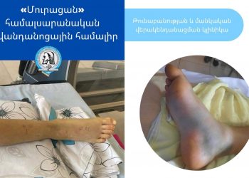 Օձը երկու տեղով կծել է 12-ամյա երեխային. վիճակը բարելավվել է