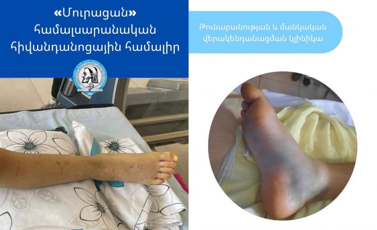 Օձը երկու տեղով կծել է 12-ամյա երեխային. վիճակը բարելավվել է