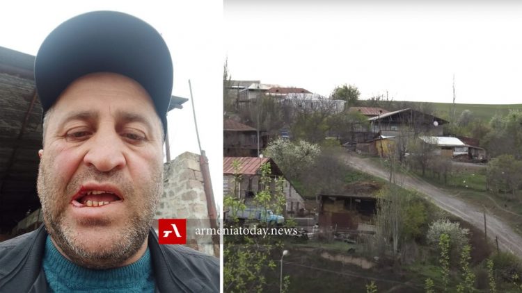 Ծեծի է ենթարկվել Տեղի ավագանու ընդդիմադիր անդամ Մասիս Զեյնալյանը (լուսանկար)