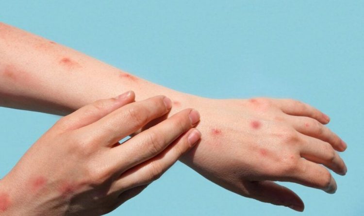 В Азербайджан проникла оспа обезьян